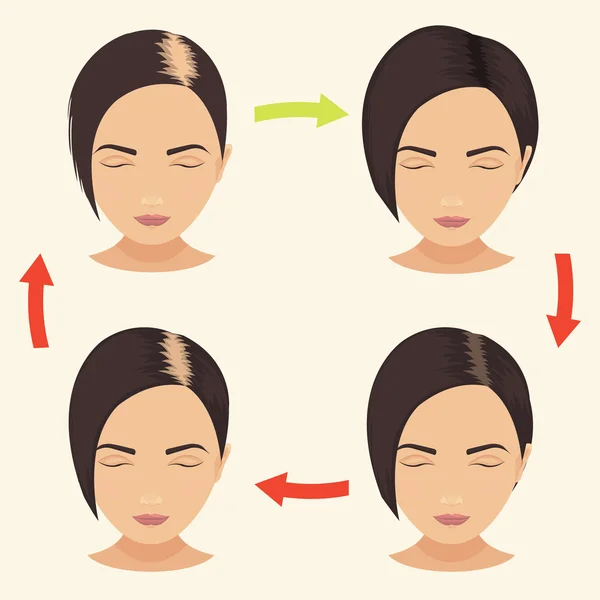 Mujer con diferentes etapas de pérdida de cabello — Vector de stock