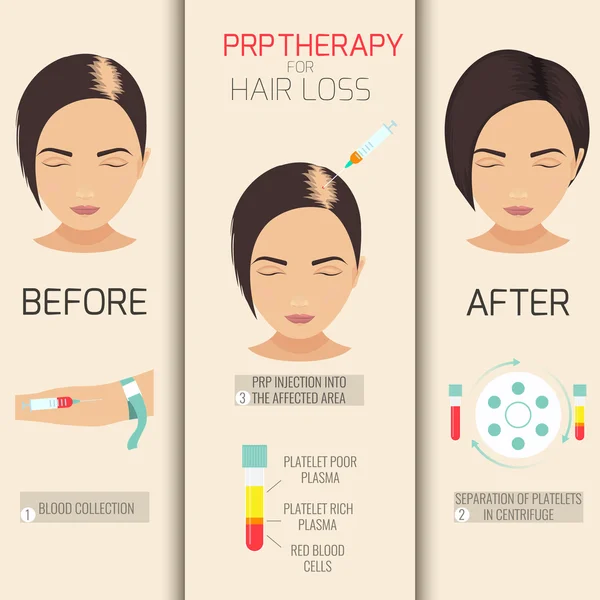 PRP therapy for hair loss — Stock Vector