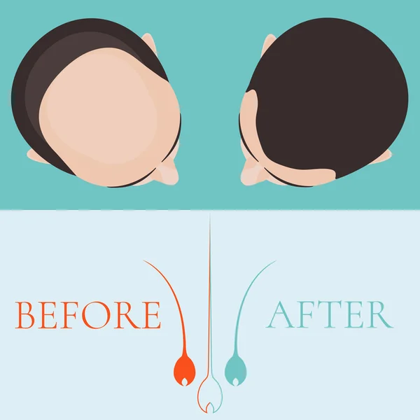 Bald man before and after hair treatment — Stock Vector