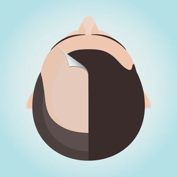 Erkek saç dökülmesi kavramı — Stok Vektör