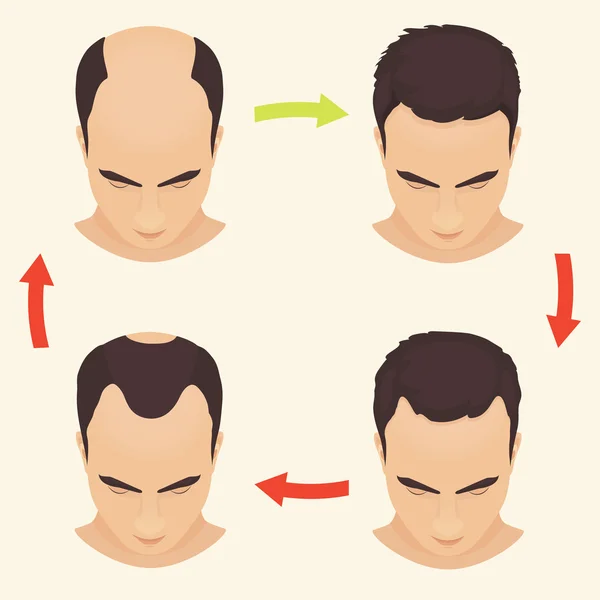 Male pattern baldness set — Stock Vector