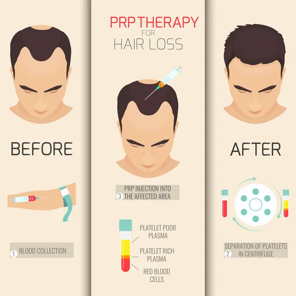 Terapia PRP para perda de cabelo — Vetor de Stock