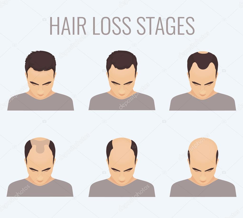 Male Pattern Baldness Cure Lupon gov ph male-pattern-baldness-cure-lupon-gov-ph