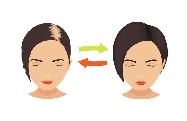 Kadınlarda saç dökülmesi — Stok Vektör
