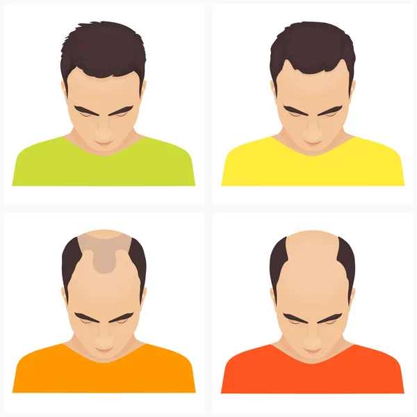 Hair loss stages in men — Stock Vector