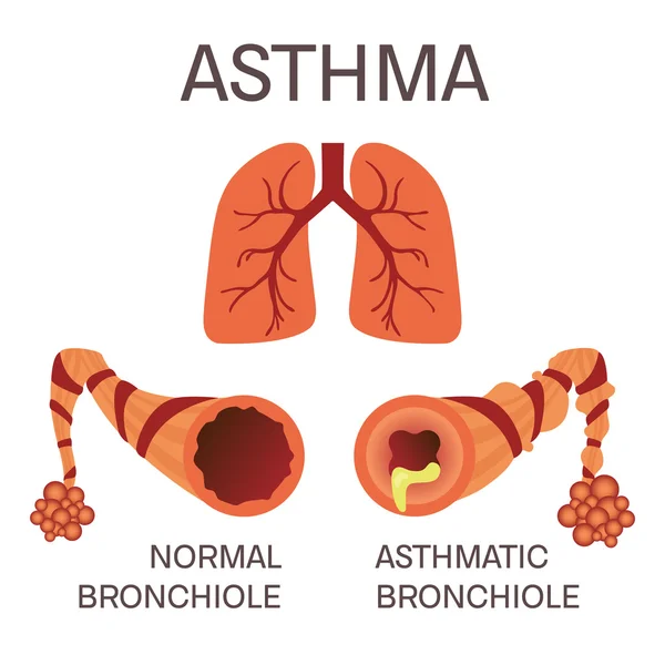 Normale en astmatische bronchioli — Stockvector