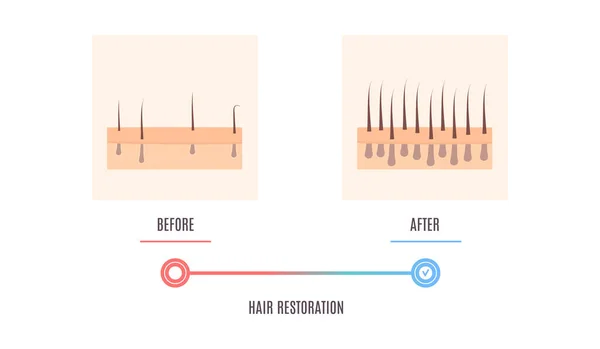 Skalp Zblízka Vlasové Folikuly Před Léčbě Alopecie Diagram Lékařské Diagnostiky — Stockový vektor