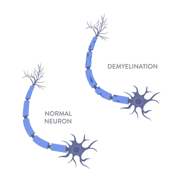 Diagramma Neuronale Sano Danneggiato Demielinizzazione Dello Shealth Neuronale Microscopio Perdita — Vettoriale Stock