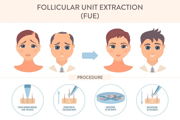 Fueによる毛髪移植脱毛症治療 女性と男性のための濾胞性ユニット抽出修復手術の段階 医療と医療の概念 ベクターイラスト — ストックベクタ