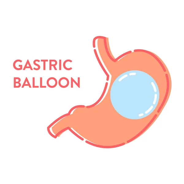 Balón Gástrico Procedimiento Pérdida Peso Quirúrgica Estómago Concepto Médico Anatomía — Archivo Imágenes Vectoriales