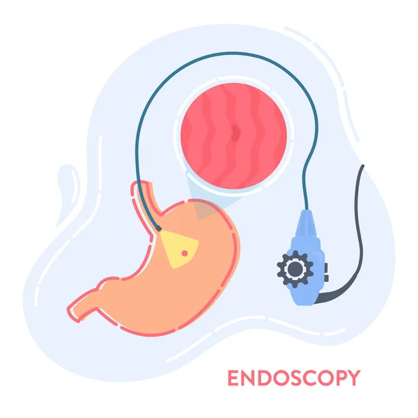 Mide Hastalığı Teşhisi Için Endoskopi Gereçleri Gastrobağırsak Yolu Muayenesi Tıbbi — Stok Vektör