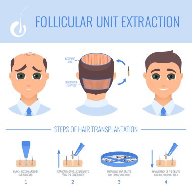 Erkek saçı kaybı FUE tıbbi tedavi. Foliküler ünite çıkarma prosedürünün aşamaları. Nakil klinikleri ve teşhis merkezleri için Alopecia bilgi tasarım şablonu. Vektör illüstrasyonu.