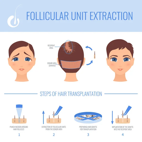 Kadın Saç Kaybı Fue Tıbbi Tedavi Foliküler Ünite Çıkarma Prosedürünün — Stok Vektör