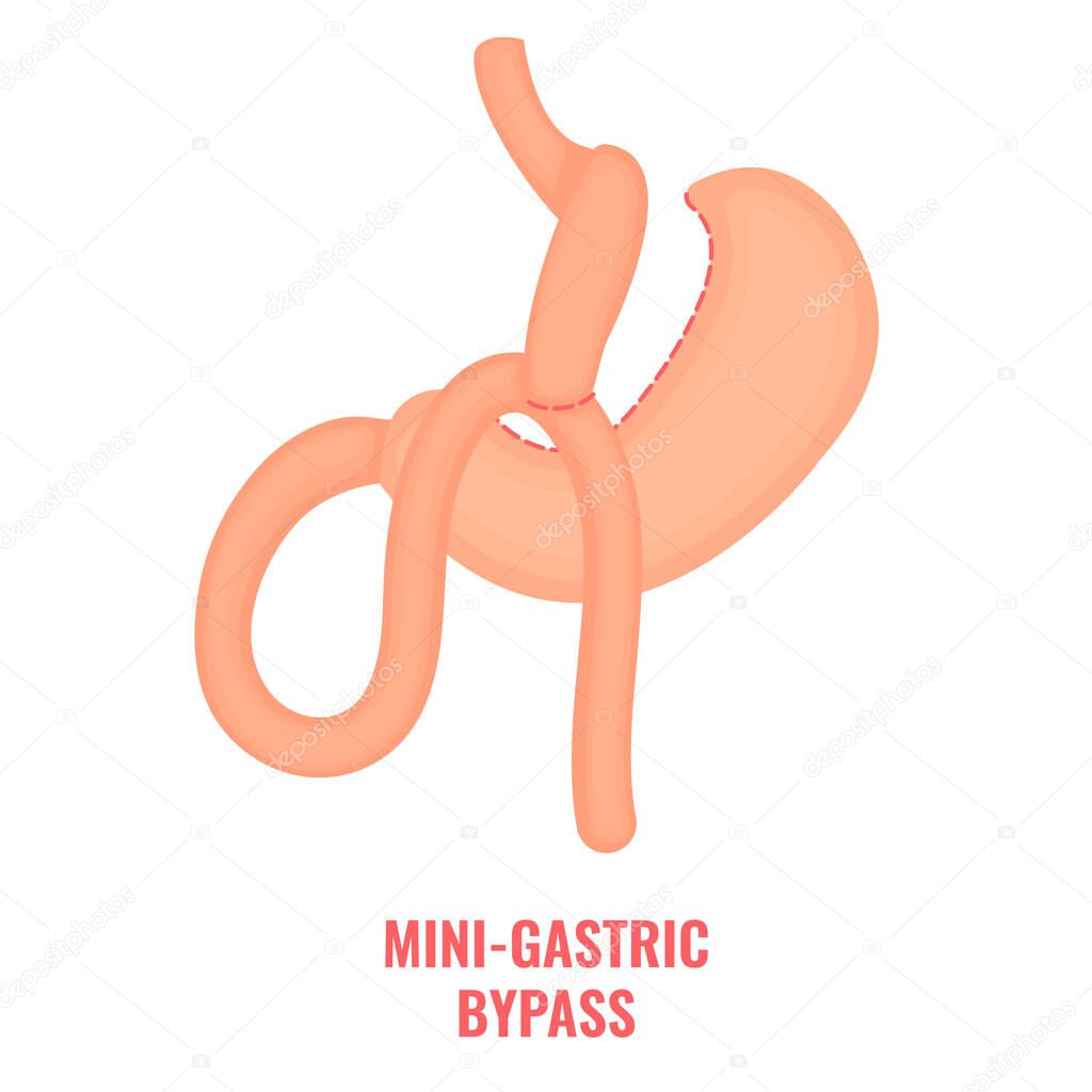 Mini gastric bypass bariatric surgery weight loss infographics