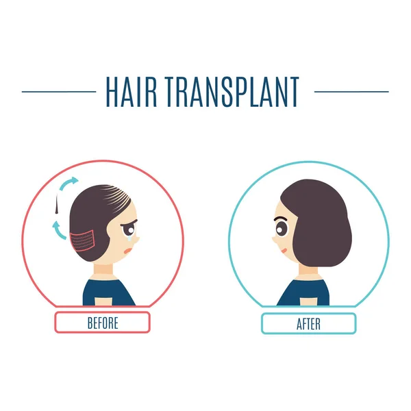 Haartransplantationsbehandlung für Frauen — Stockvektor