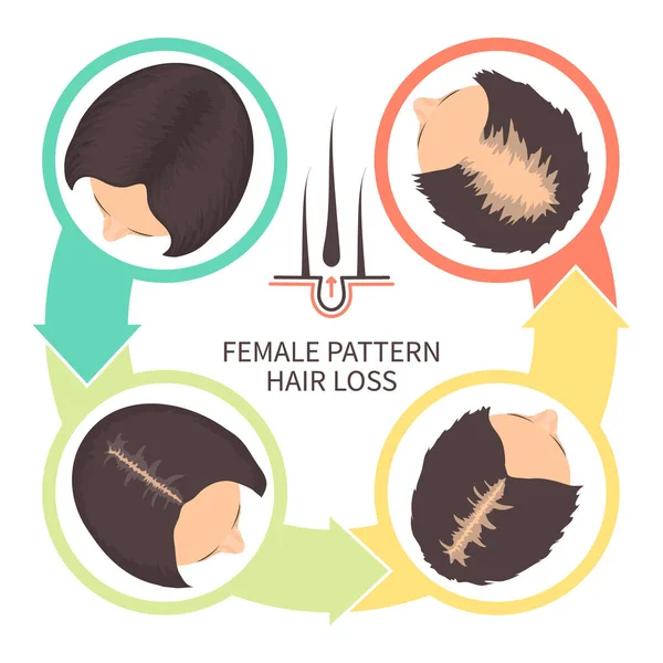 Female Pattern Hair Loss Set Stages Baldness Women Androgenetic Alopecia — Stock Vector