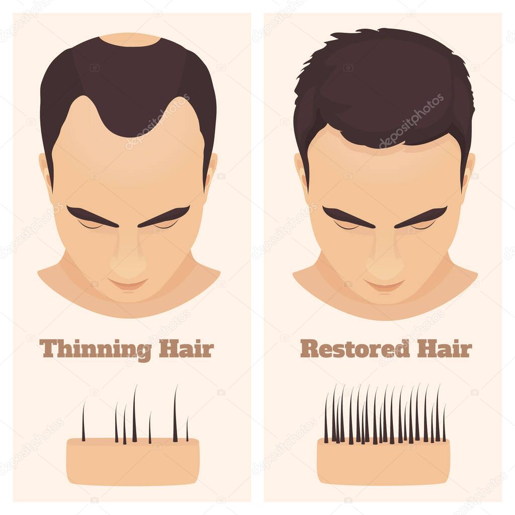 Male pattern alopecia set. Medical educational poster.