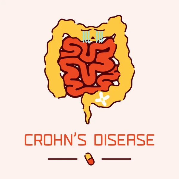 Poster penyakit Crohns - Stok Vektor