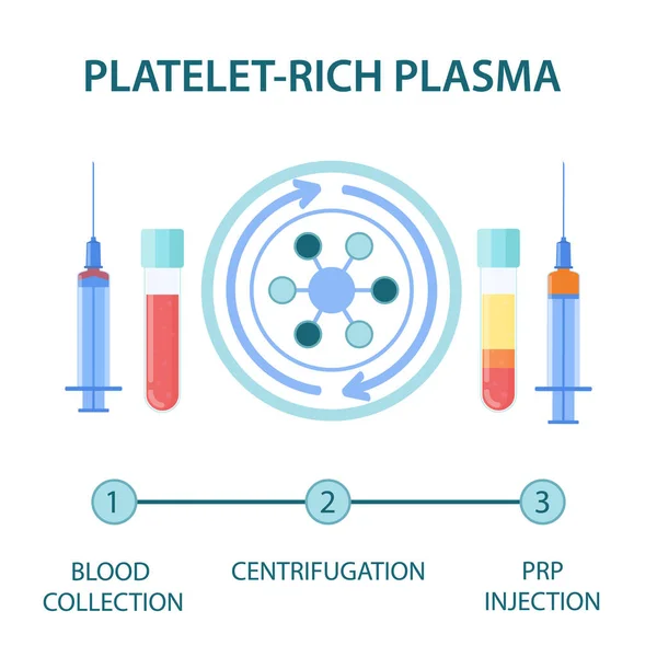 Medizinische Infografiken für Plättchenreiches Plasma-Verfahren — Stockvektor