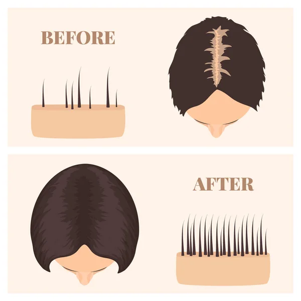 Donna in vista dall'alto prima e dopo il trattamento di perdita dei capelli — Vettoriale Stock