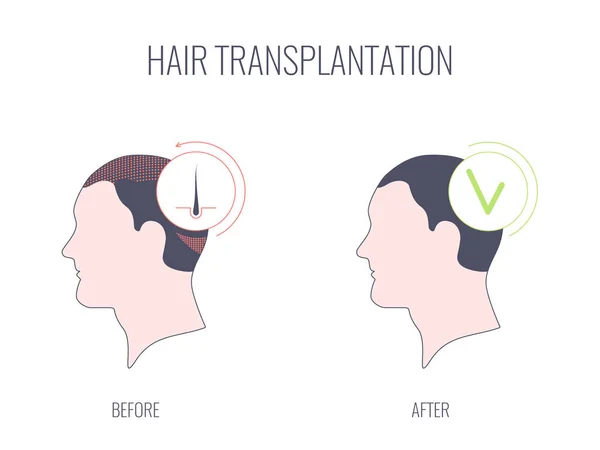 Trasplante de cabello concepto médico lineal de tratamiento exitoso — Vector de stock