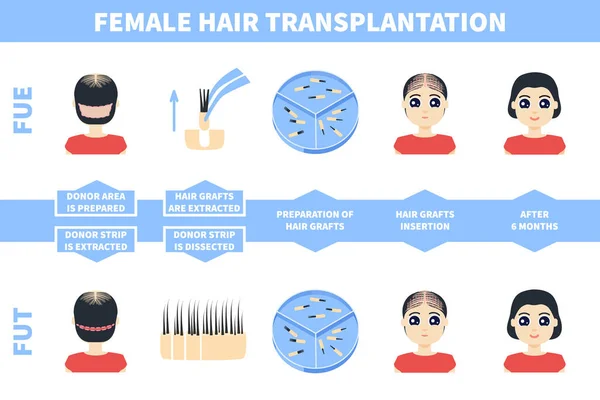 Transplantation de cheveux masculins avec FUE, méthodes FUT — Image vectorielle