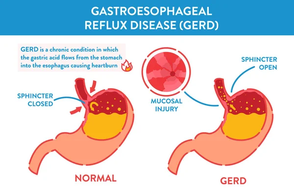 GERD Magensäure-Reflux-Krankheit Infografik medizinisches Poster — Stockvektor