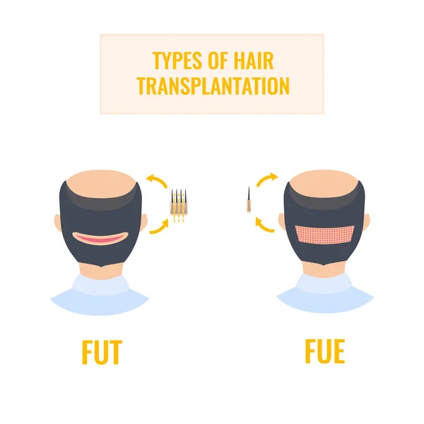Інфографіка трансплантації волосся методами FUT та FUE — стоковий вектор