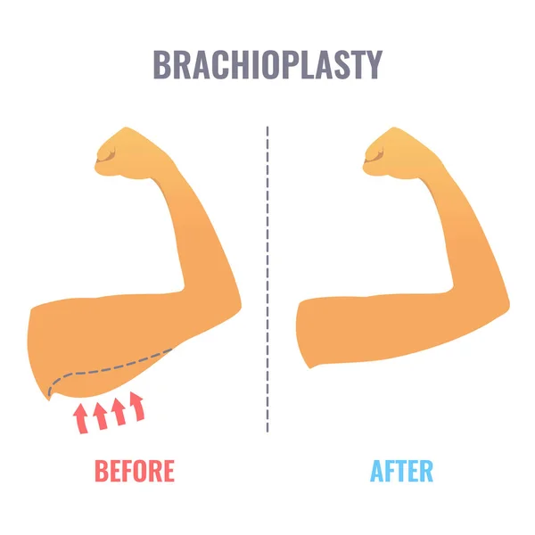 Brachioplastiek armlift chirurgie infographic medische poster — Stockvector