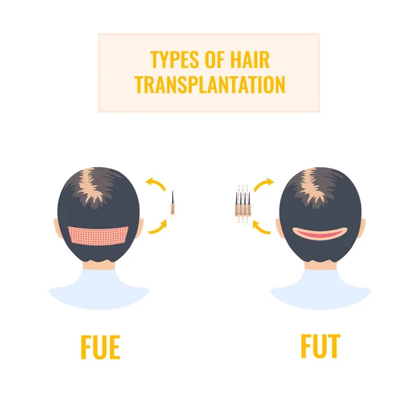 Infografiken der FUT und FUE Methoden für weibliche Haartransplantation — Stockvektor