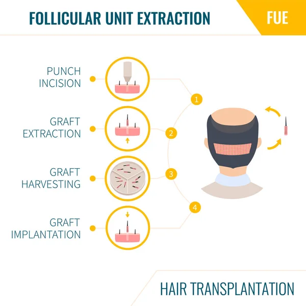 Hair transplantation by FUE method in men — 스톡 벡터