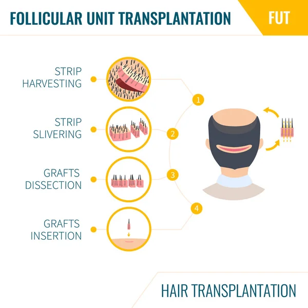 Hair transplantation by FUT method in men — Stock Vector