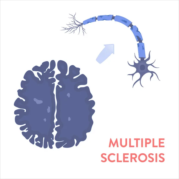 Cerebro afectado por esclerosis múltiple, ilustración de resonancia magnética — Vector de stock