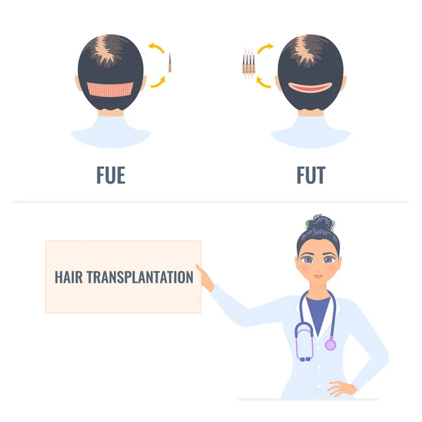 Transplantace vlasů infografie léčby ženské alopecie — Stockový vektor