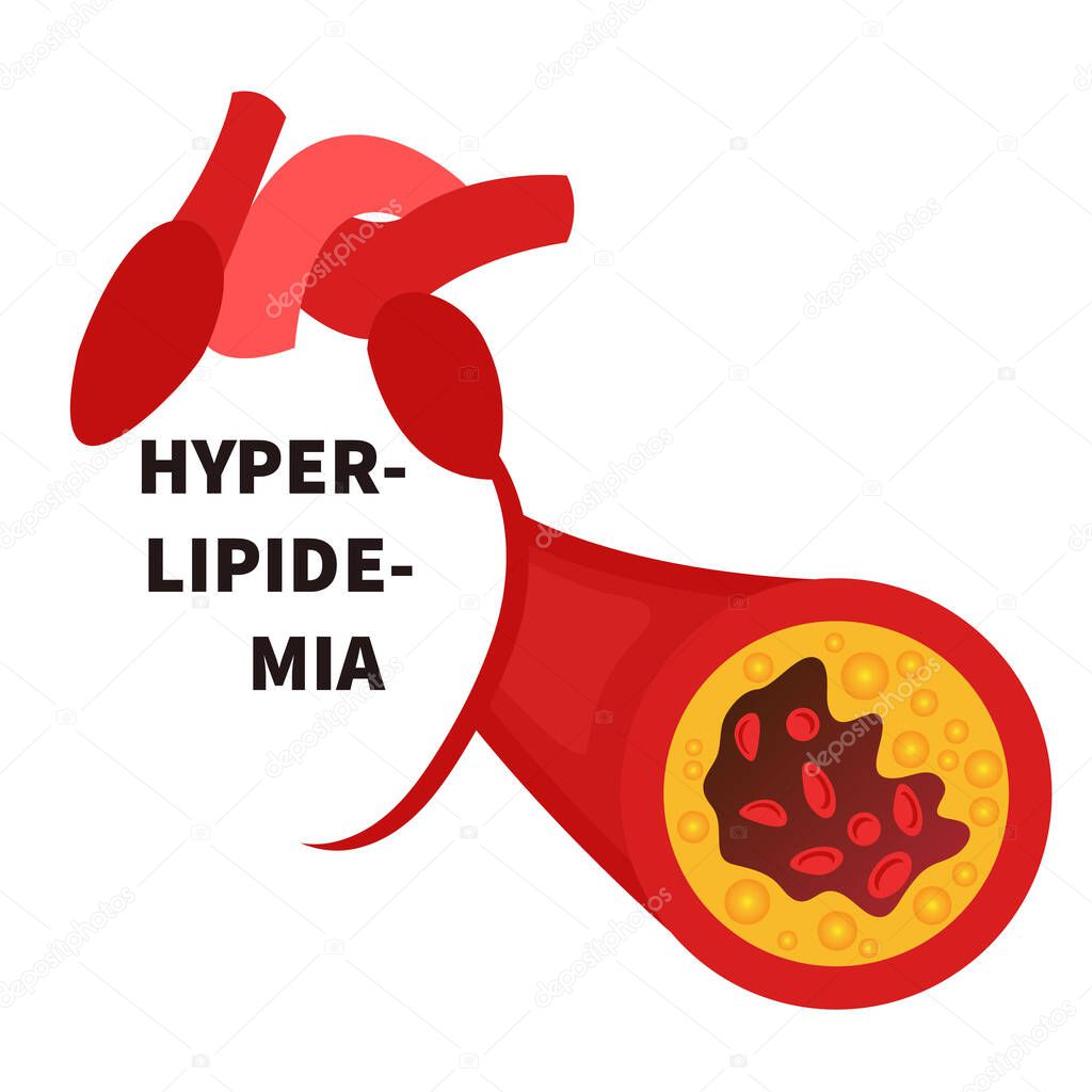Hyperlipidemia conceptual illustration of blocked blood artery vessel 