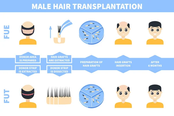 Transplantation de cheveux masculins avec FUE, méthodes FUT — Image vectorielle