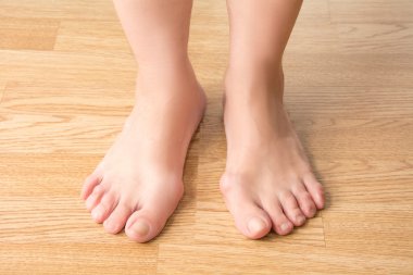 Hallux valgus, şişik ayak, bacaklarda ağrı