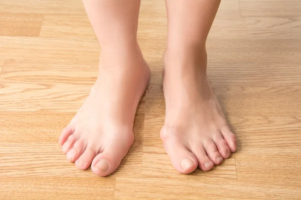 Hallux valgus, bunion in foot, pain in the legs — Stock Photo, Image