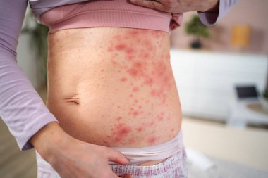 Karın ve yanlarda kızarıklık gösteren bir kadın. Alerjik bir reaksiyon ya da cilt hastalığı olabilir.