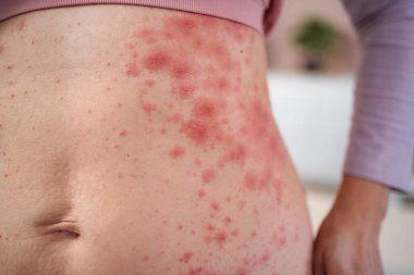 Kadının karnında ve yan vücudunda alerjik deri döküntüleri var.