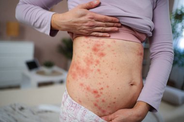 Karnına dokunan kadın, acı veren alerjik deri döküntüsünden muzdarip.