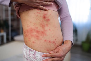 Kırmızı deri kızarıklığı gösteren kişi muhtemelen alerji ya da enfeksiyondan.