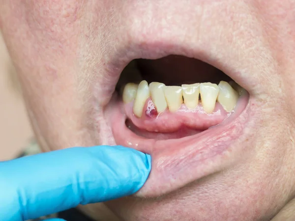 Sakızda bir apse oluşmuş. İçinde iltihap olan bir tümör. Dişçi muayenesi.