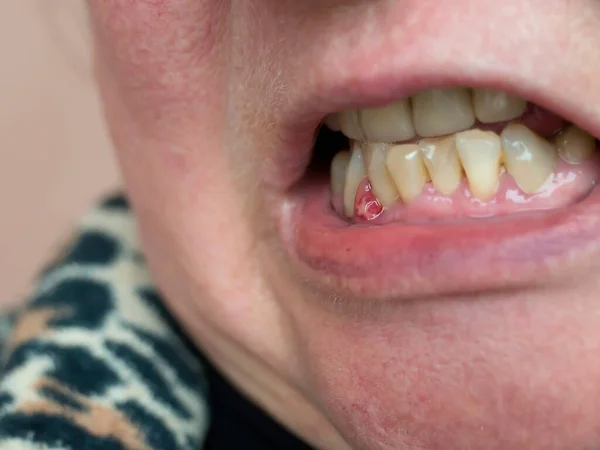 Encía Formó Absceso Tumor Con Contenido Purulento Examen Odontológico — Foto de Stock