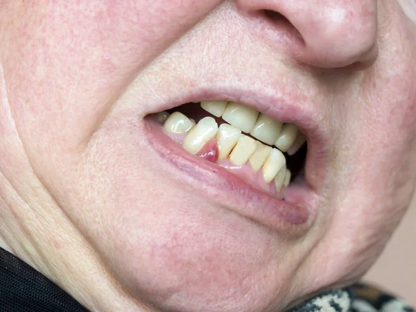 Sakızda bir apse oluşmuş. İçinde iltihap olan bir tümör. Dişçi muayenesi.