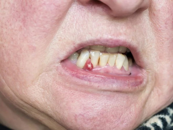 Sakızda bir apse oluşmuş. İçinde iltihap olan bir tümör. Dişçi muayenesi.