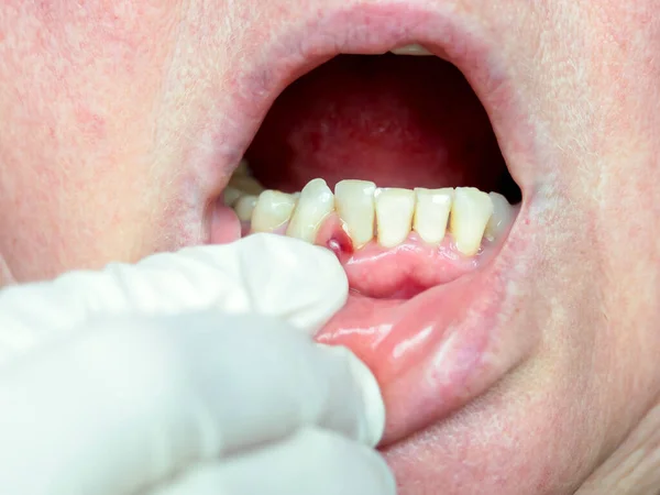 Tandköttet Bildas Böld Tumör Med Purulent Innehåll Tandläkarundersökning — Stockfoto