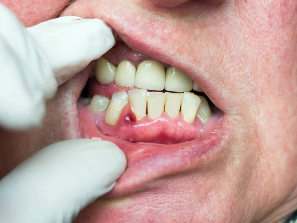Encía Formó Absceso Tumor Con Contenido Purulento Examen Odontológico Fotos de stock libres de derechos