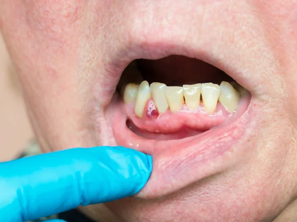 Sulla Gengiva Formato Ascesso Tumore Con Contenuto Purulento Esame Dentistico Foto Stock