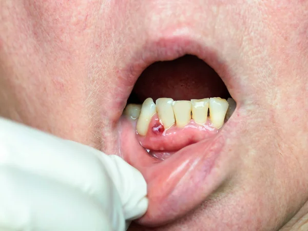 Gum Abscess Formed Tumor Purulent Contents Dentist Examination Royalty Free Stock Images